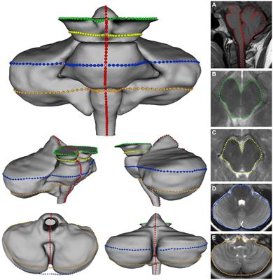 Geometric morphometric analysis of the brainstem and cerebellum in Chiari I malformation